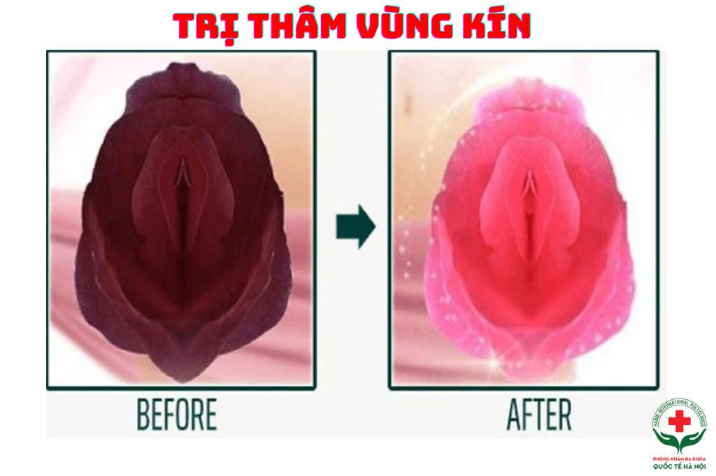 tri-tham-vung-kin