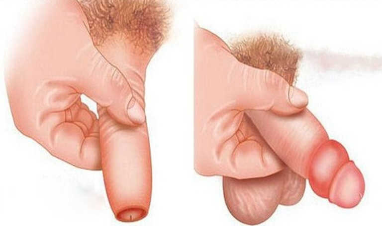 Bệnh hẹp bao quy đầu xuất hiện khi quy đầu nam giới bị bịt kín bởi lớp da bao quy đầu quá chật hẹp