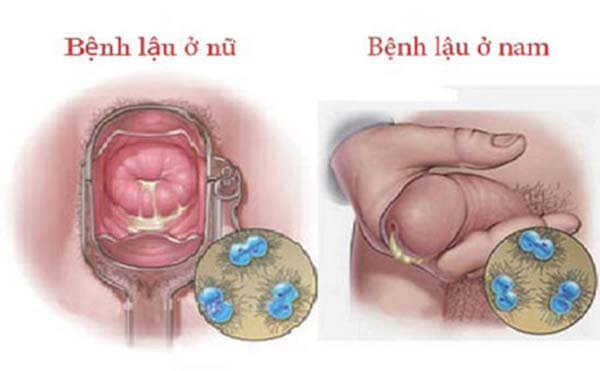 Những triệu chứng mắc bệnh lậu ở các bộ phận khác nhau trên cơ thể: bộ phận sinh dục
