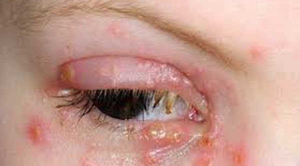 Những triệu chứng mắc bệnh lậu ở các bộ phận khác nhau trên cơ thể: Mắt