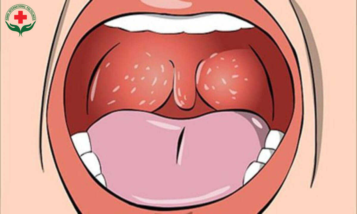 Lậu ở miệng là bệnh gì?