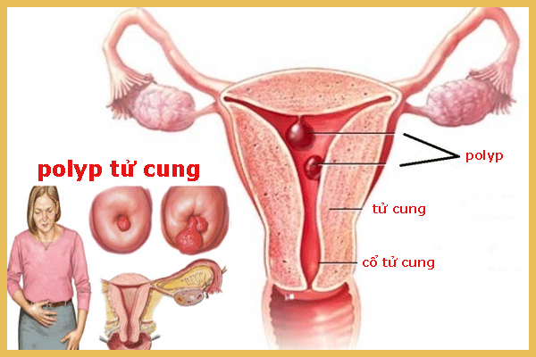 Polyp cổ tử cung là tình trạng tăng sinh bất thường của các tế bào trên cổ tử cung.