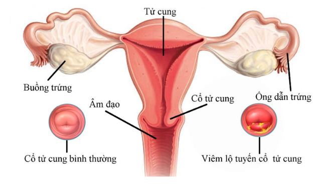 Lộ tuyến cổ tử cung là tình trạng tổn thương lành tính ở cổ tử cung do các tế bào tuyến nằm trong cổ tử cung phát triển, xâm lấn mặt ngoài cổ tử cung.