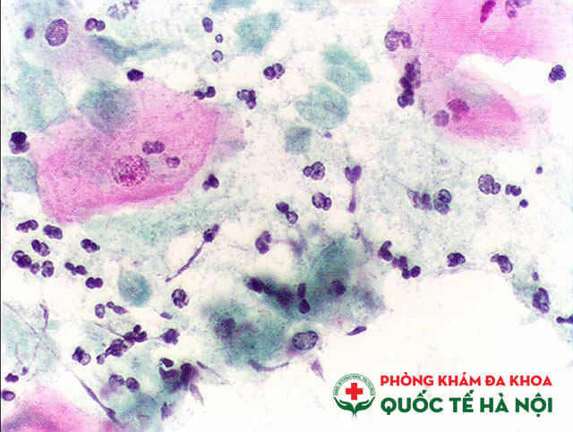 Viêm âm đạo do Trichomoniasis là bệnh lây nhiễm qua đường tình dục (STD)