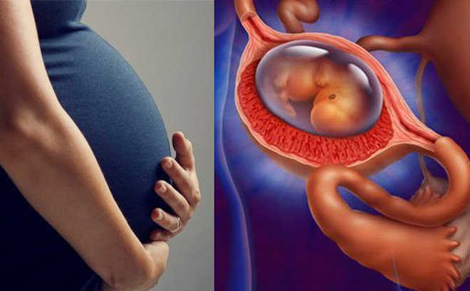 Mang thai ngoài tử cung