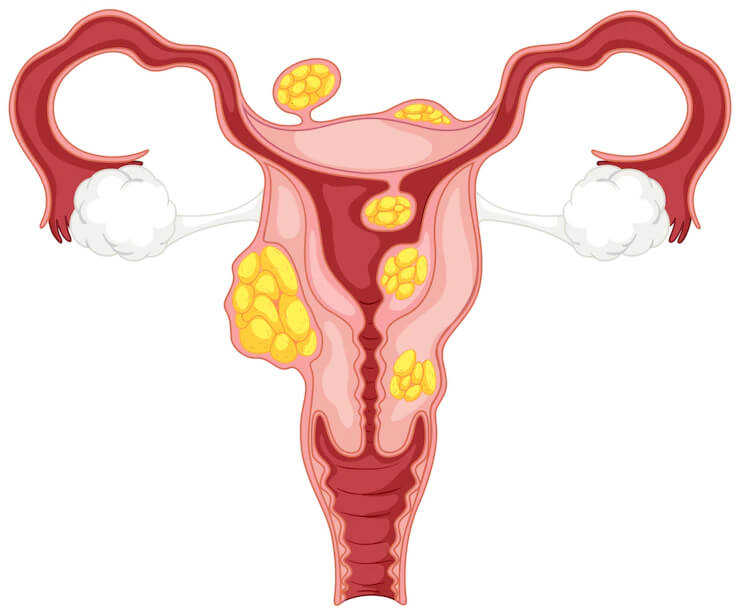 U xơ tử cung: nguyên nhân gây vô sinh ở nữ giới