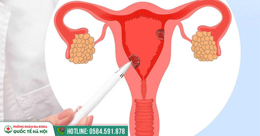Hội chứng buồng trứng đa nang (PCOS): nguyên nhân vô sinh nữ phổ biến