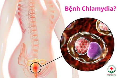 benh-chlamydia